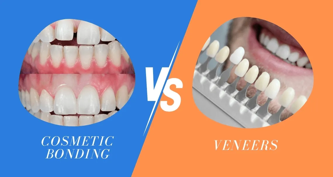 Dental Bonding vs Veneers | Pros, Cons, Costs Explained Dental Bonding vs Veneers